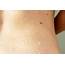 Small Bumps On My Back  Dorothee Padraig South West Skin Health Care