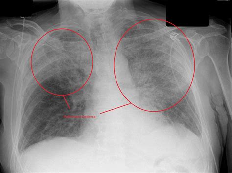 Initial Chest Xray Revealed Interstitial Pulmonary Edema