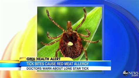 Lone Star Tick Bite Can Make You Allergic To Red Meat Youtube