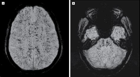 Cerebral Microhemorrhages Caused By Acute Dic Cerebrovascular Disease