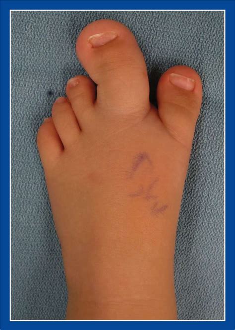 Foot Malformations Musculoskeletal Key