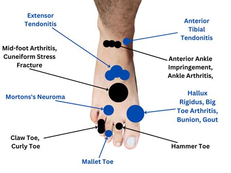 The Ultimate Foot Pain Chart Everything You Need To Know Medicure Wise