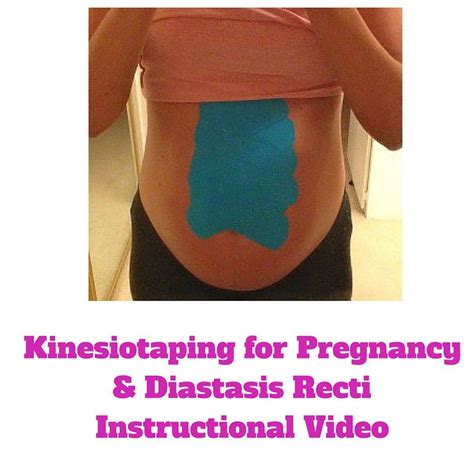Kinesiotaping For Diastasis Recti Post Pregnancy Workout Prenatal