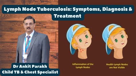 Lymph Node Tuberculosis Symptoms Diagnosis And Treatment I Dr Ankit