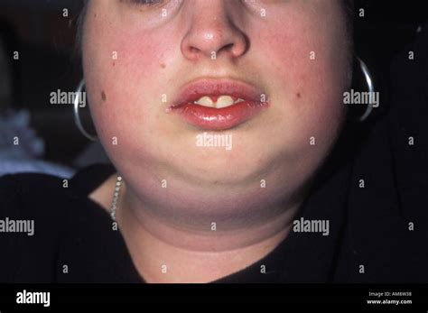 Parotitis Due To Mumps Virus Infection Stock Photo Royalty Free Image