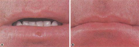 Actinic Cheilitis Treatment With The Carbon Dioxide Laser Mayo