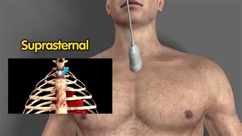 Echocardiographic View Suprasternal Notch Suprasternal Long Axis