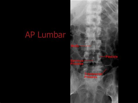 Ppt Normal X Ray Anatomy Powerpoint Presentation Id867049