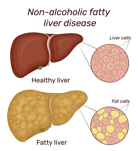 Understanding Fatty Liver Disease Ask The Nurse Expert