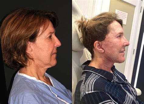 Deep Plane Facelift Patient Results From Dr Andrew Jacono 1 Day Post Surgery Face Plastic