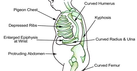 Medical Students Blog Rickets Clinical Features