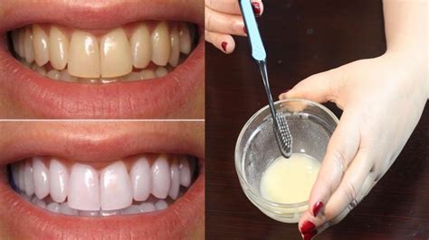 How To Whiten Teeth Best Teeth Whitening Method Teeth Whitening At