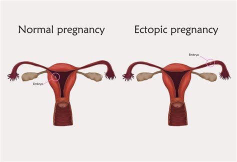 What Are The Odds Of Having An Ectopic Pregnancy Again
