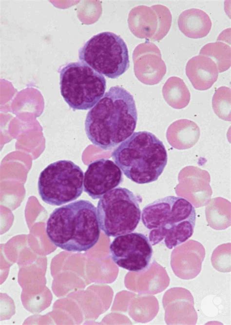 Adult T Cell Leukemialymphoma 1