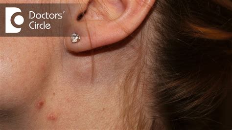 Lump Below Left Ear Lobe Ovulation Symptoms