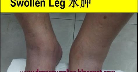 Tcm News Swollen Legs