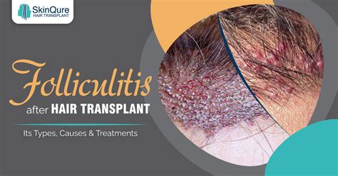 Folliculitis After Hair Transplant Its Types Causes And Treatments