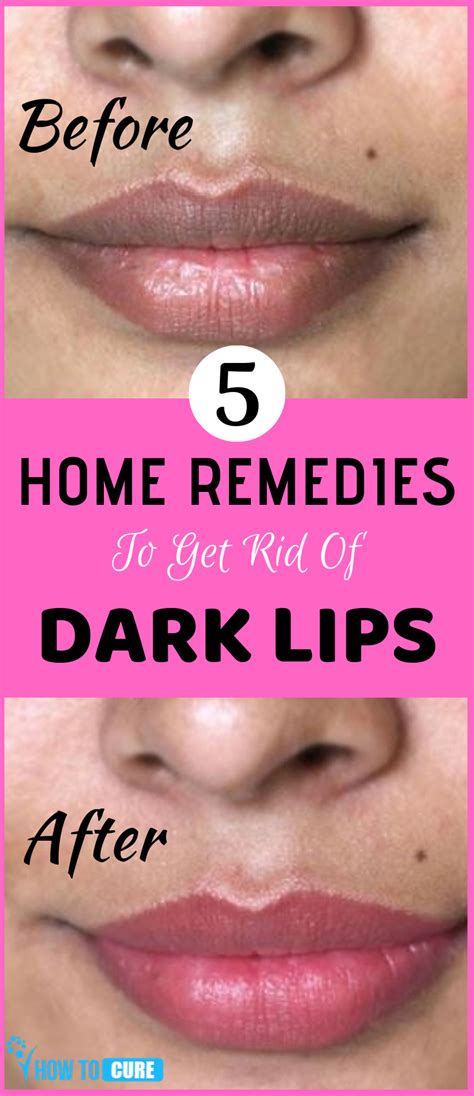 Consider These Natural Remedies To Lighten Up Dark Lips In 2020 Dark