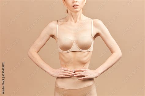 Skinny Anorexic Girls Nude Thinspiration Pichunter My Xxx Hot Girl