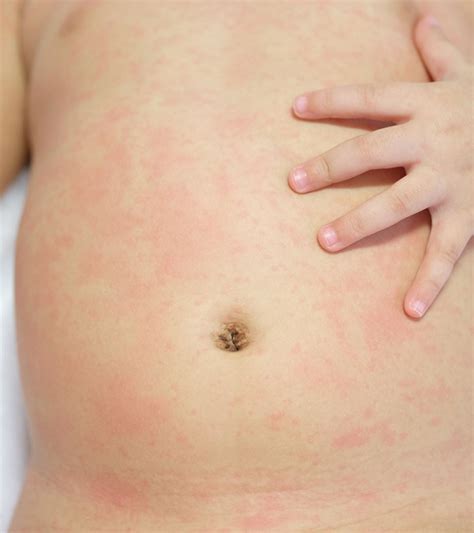 Causes Of Roseola In Toddlers Signs Treatment And Prevention Momjunction