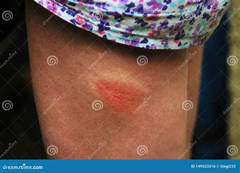 Painful Insect Bite Stock Photo Image Of Allergic Sting 149533316