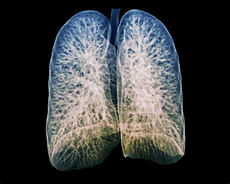 Healthy Lungs Photograph By Zephyr Fine Art America