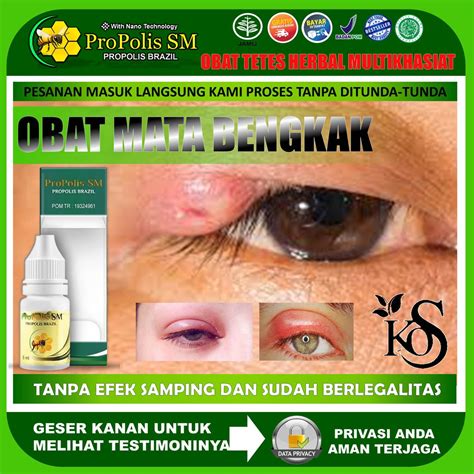 Jual Propolis Sm Brazil Obat Oles Mata Bengkak Bintitan Gede Sebelah