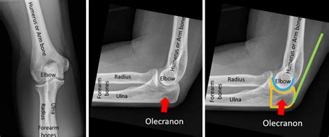 Olecranon Fracture Orthopaedic Trauma Association Ota