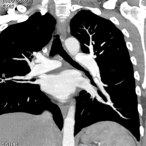 Ct Pulmonary Angiography Ctpa Pvri