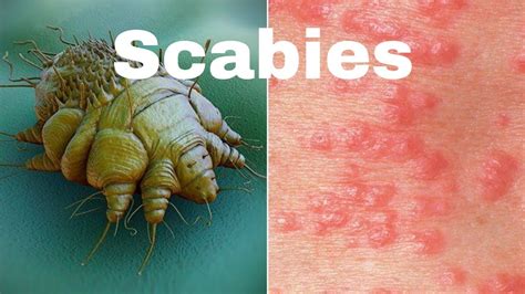scabies the itch cause symptoms treatment nursing lecture in hindi medical surgical