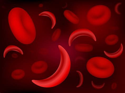 What is sickle cell anemia? Sickle Cell Anemia | Germany| PDF | PPT| Case Reports ...