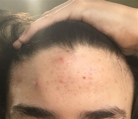 Acne What Else Can I Do To Help My Forehead Rskincareaddiction