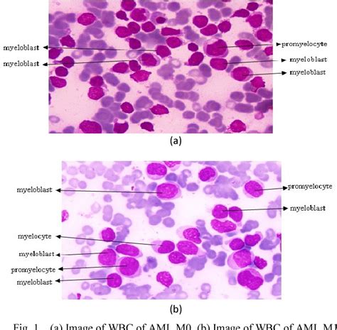 Cells Identification Of Acute Myeloid Leukemia Aml M0 And Aml M1 Using