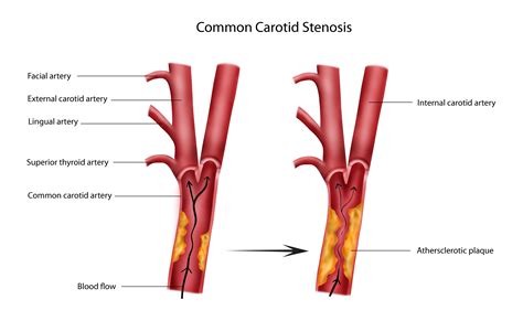 Pathophysiology Stenosis Carotid Artery Superior Thyroid Artery