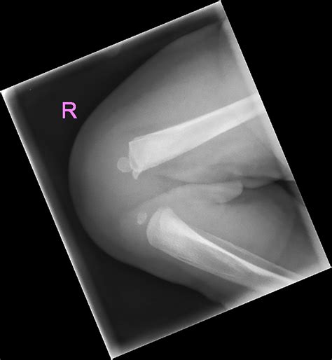 Congenital Knee Dislocation A Rare And Unexpected Finding Bmj Case