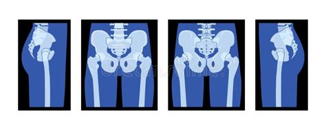 Set Of X Ray Pelvis And Femur Skeleton Hip Human Body Bones Adult
