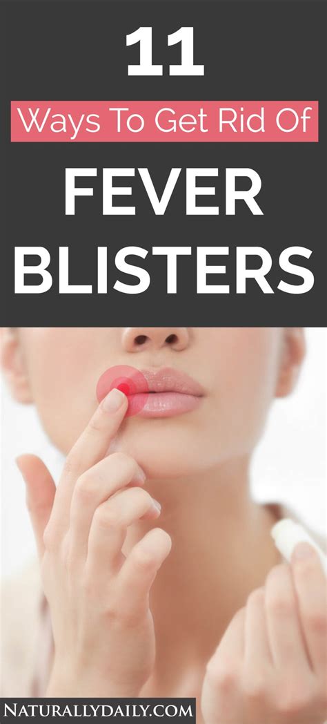 How To Get Rid Of Blisters 24 Possible Home Remedies