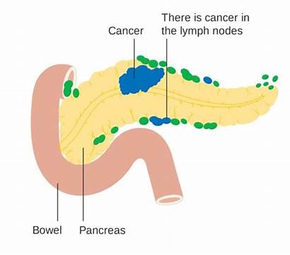 Pancreatic Cancer Lymph Nodes Diabetes Svg Diagram