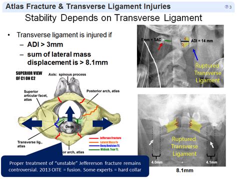 Atlas Fractures Transverse Ligament Injuries Spine Orthobullets My