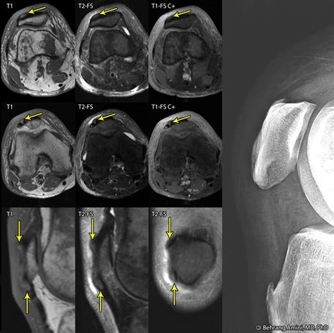 Roentgen Ray Reader Gout Of The Extensor Mechanism Of The Knee