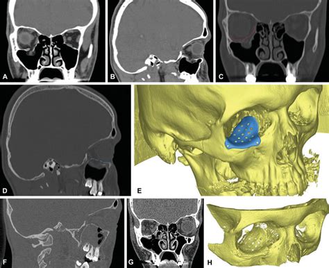 Patient K With Blowout Fracture Of The Right Orbit 3 Weeks After