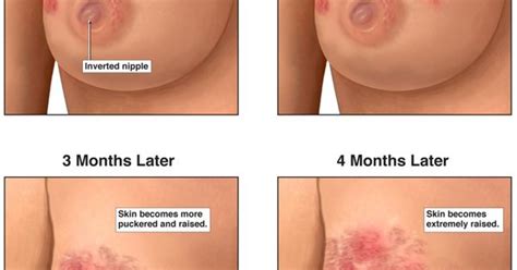 You also may develop red, inflamed skin on the breast. inflammatory Breast Cancer Is rare while breastfeeding but ...
