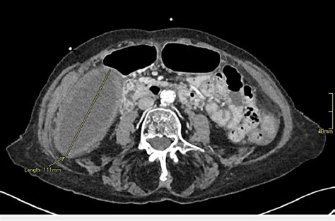 Axial Contrast Enhanced Computed Tomography Of The Abdomen And Pelvis