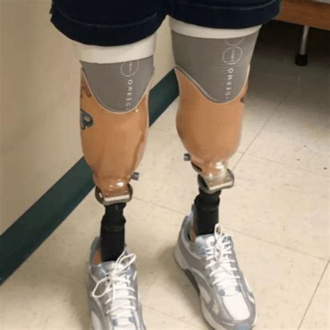 Life After Leg Amputation 5 Things To Know About Prosthetic Legs