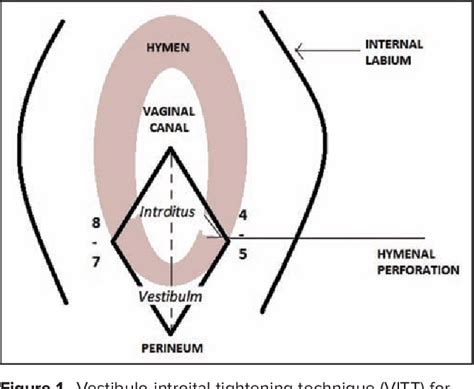 Figure From A New Practical Surgical Technique For Hymenoplasty Primary Repair Of Hymen With