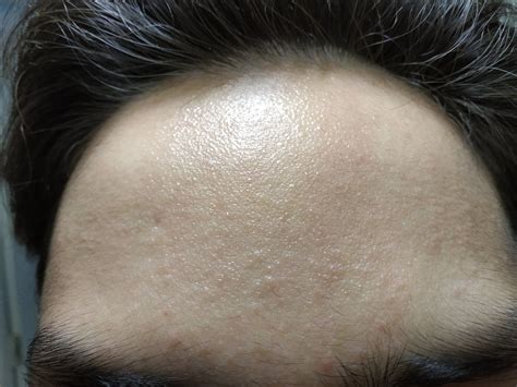 Rough Bumpy And Sandy Texture Especially On Forehead And Thousands Of