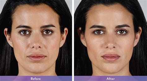 Juvederm Vollure Xc Dermatology Banki Dermatology And Cosmetic Center