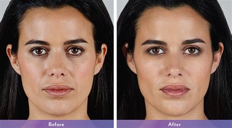 How long does trimix last after injection. Juvederm Vollure XC - Dermatology - Banki Dermatology ...
