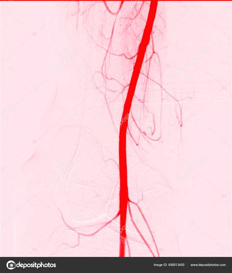 Femoral Angiogram Medical Procedure Used Visualize Blood Vessels Groin