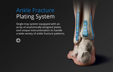 Implant Systems Unite Foot And Ankle Development Site